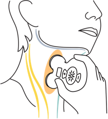 gammaCore (nVNS) is a non-invasive vagus nerve stimulator illustration of applying dose